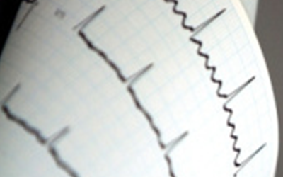 Prueba de esfuerzo electrocardiograma