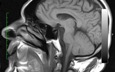 Accidente cerebrovascular (ACV) hemorrágico