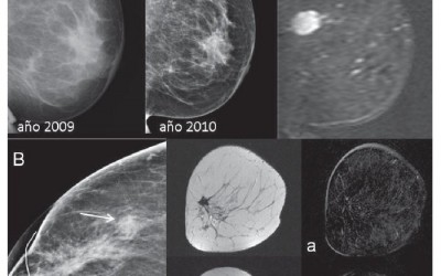 Tipos de cáncer de mama