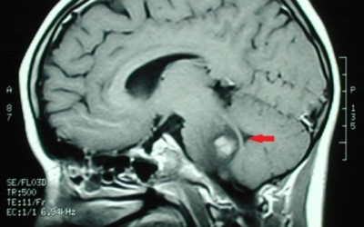 Neuroblastoma cáncer infantil