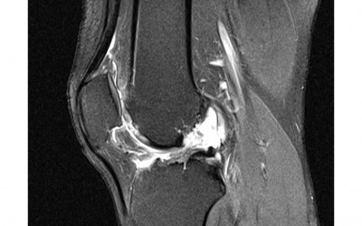 Lesiones del Ligamento Cruzado Anterior (LCA)
