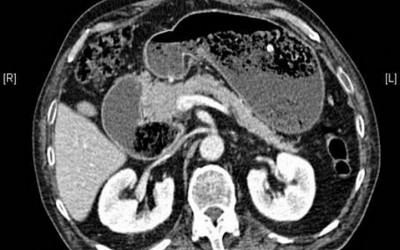 Hígado graso y fibrosis hepática