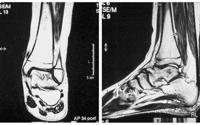 Disgnóstico de osteomielitis