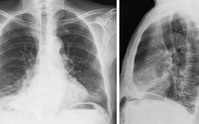 Importancia de la radiografía de Torax