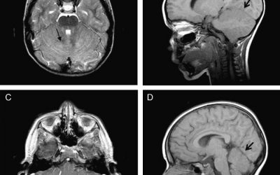 Ataxia cerebelosa aguda en niños