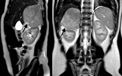 Adenoma suprarrenal Diagnóstico