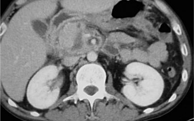 Pancreatitis Síntomas y diagnóstico